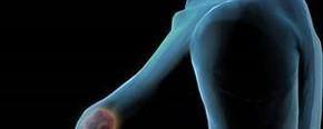 女性必知：乳腺癌早期五大症状