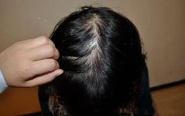 掉发的原因有哪些 经常熬夜、过度运动头发护理不当