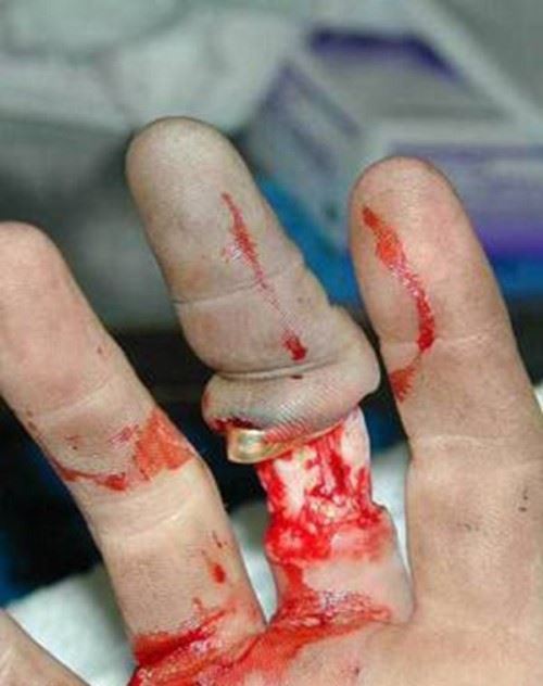 打保龄球戴戒指 手指上的肉会被活生生的剥落