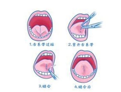 如何矫正大舌头？怎样判断是不是大舌头吐字不清发音不准